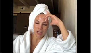 “Me obsesioné”: Fabiola Campomanes muestra daños en el rostro por tratamientos de belleza